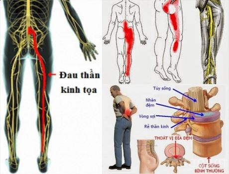 <strong>Đau thần kinh tọa</strong><strong> (Sciatica pain)</strong><strong></strong>