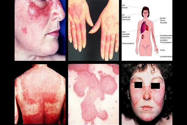 CHẨN ĐOÁN VÀ ĐIỀU TRỊ BỆNH LUPUS BAN ĐỎ HỆ THỐNG (Systemic lupus erythematosus- SLE) THEO PHÁC ĐỒ CỦA BYT