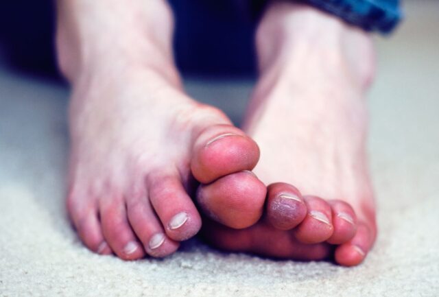 Bàn chân lạnh là dấu hiệu của bệnh gì?